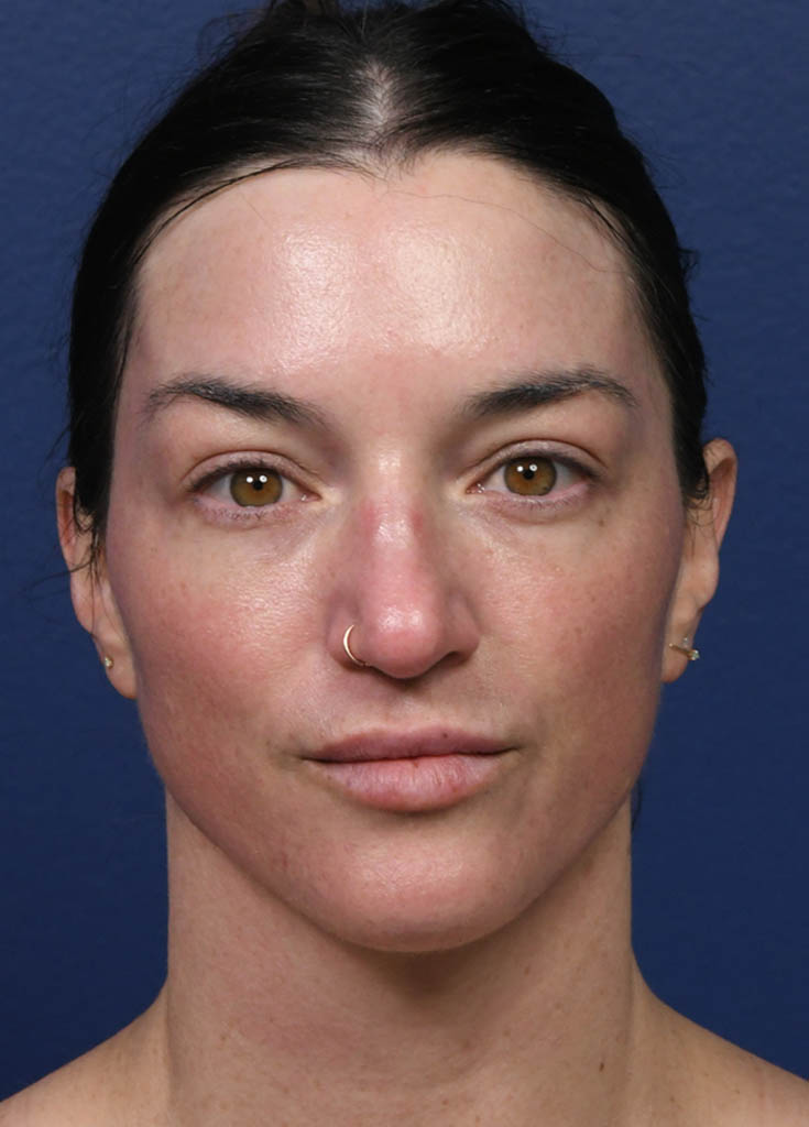 1_0020_Tribrid Laser Frontal Post Treatment.JPG