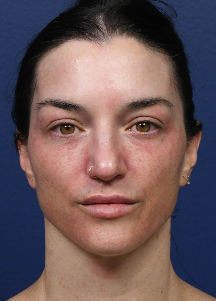 1_0021_Tribrid Laser Frontal Pre Treatment’.JPG