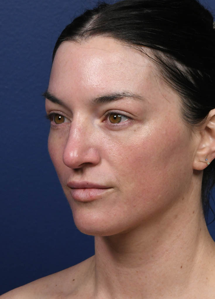1_0022_Tribrid Laser Oblique 1 Post Treatment.JPG