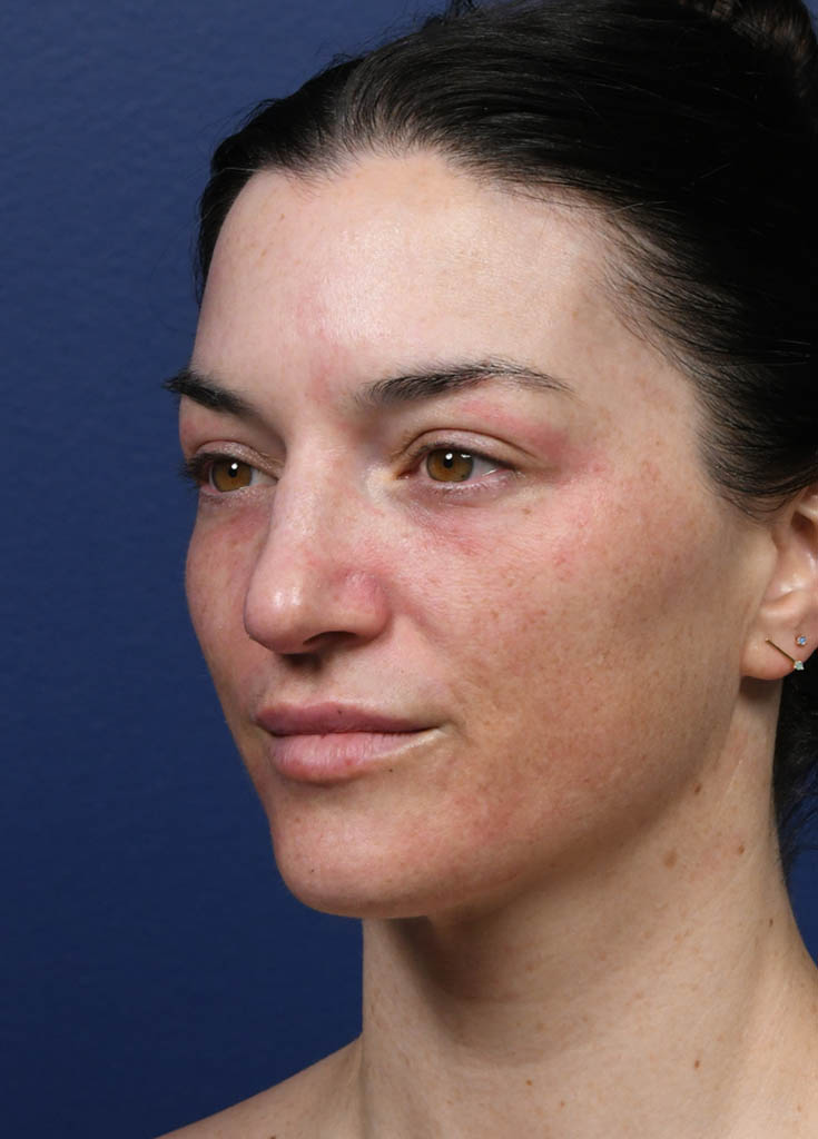 1_0023_Tribrid Laser Oblique 1 Pre Treatment.JPG
