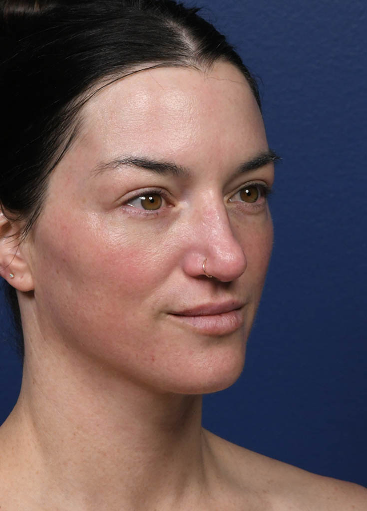 1_0024_Tribrid Laser Oblique 2 Post treatment.JPG