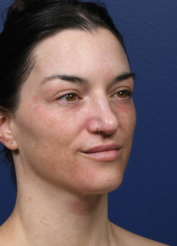 1_0025_Tribrid Laser Oblique 2 Pre Treatment.JPG