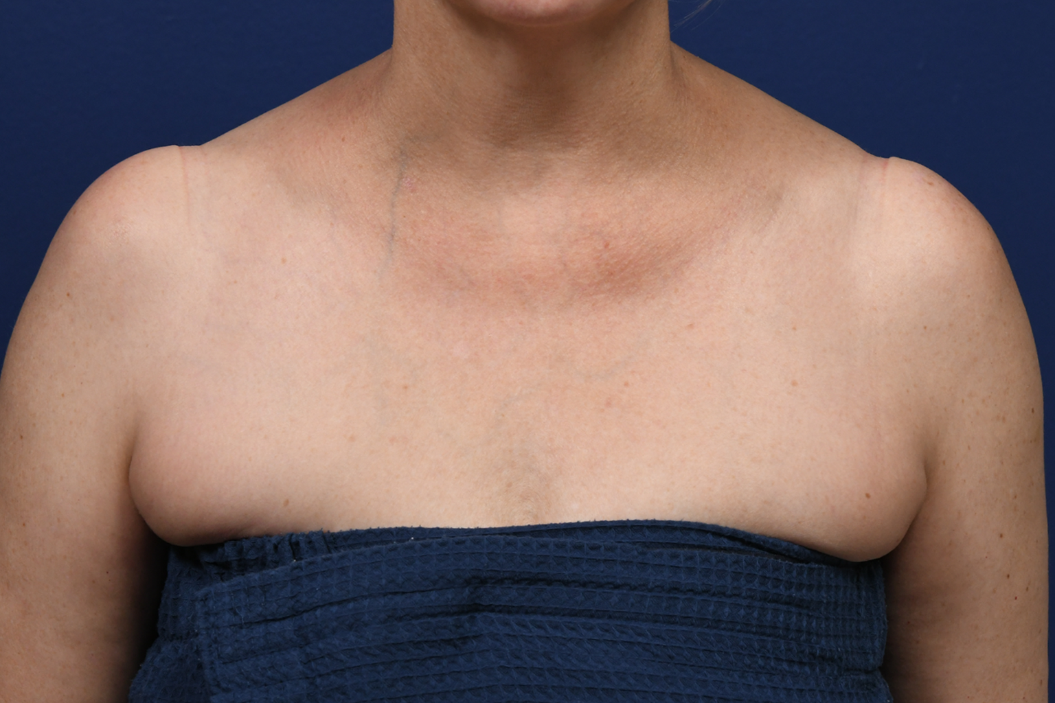 BBL Case 1 Post Op Chest.JPG