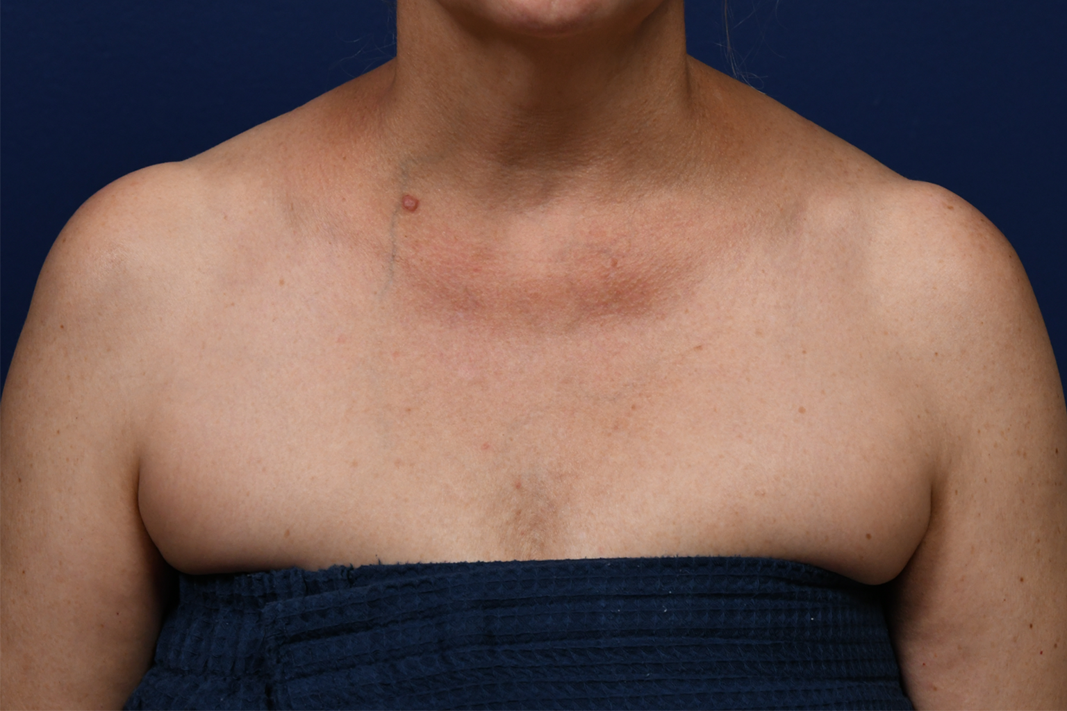 BBL Case 1 Pre OP Chest.JPG