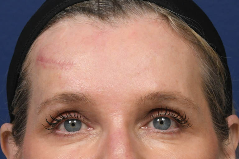 a_0028_PM Pre Op Frontal.JPG