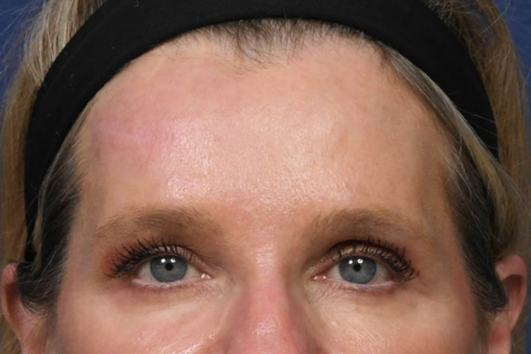 a_0029_PM Post Op Frontal.JPG