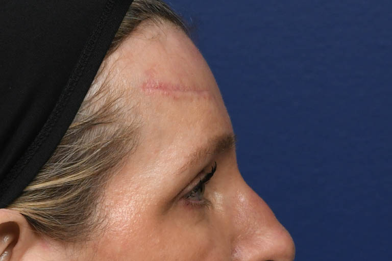 a_0030_PM Pre Op Profile 2.JPG